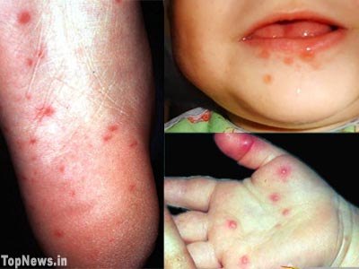 herpes pictures in mouth. and Mouth Disease and know