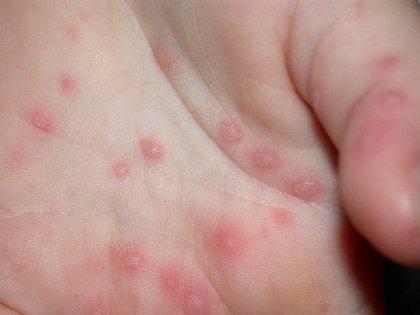 About Hand, Foot, and Mouth Disease (HFMD)