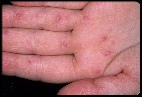 Hand Foot And Mouth Virus In Adults 3