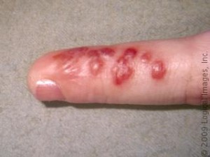 Herpetic Whitlow - Pictures, Symptoms, Causes and ...
