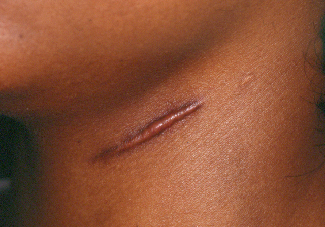hypertrophic scars removal