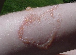 Poison Ivy Rash – Pictures, Causes, Contagiousness, Duration and Treatment