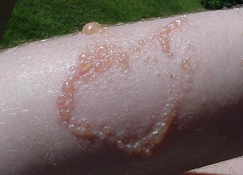 poison ivy rashes. Picture 3 – Severe Poison Ivy