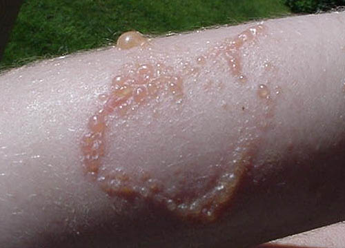 poison ivy rash pics. Picture 3 – Severe Poison Ivy