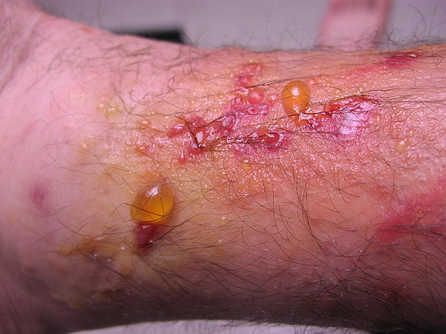 poison ivy rash treatment. Poison Ivy Rash Description