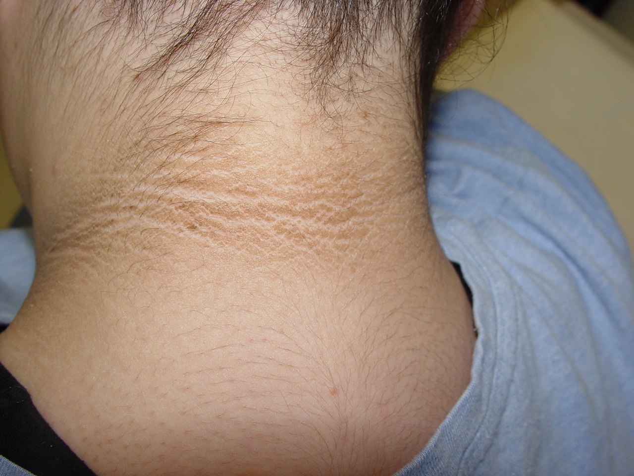 Acanthosis nigricans in obese patients:.