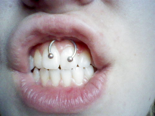 piercing infection. Picture 2 – Smiley Piercing