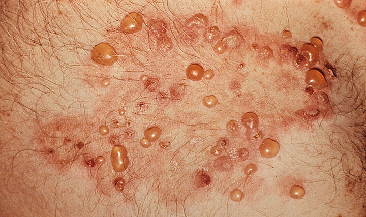 Seborrheic dermatitis (including dandruff and cradle cap)