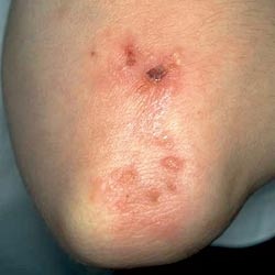 dapsone in treatment of dermatitis herpetiformis