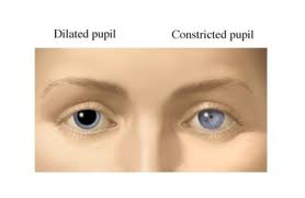 Unilateral Dilated Pupil Children
