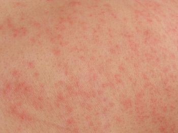 Amoxicillin Rash â€“ Pictures, Causes, Symptoms, Precautions and ...