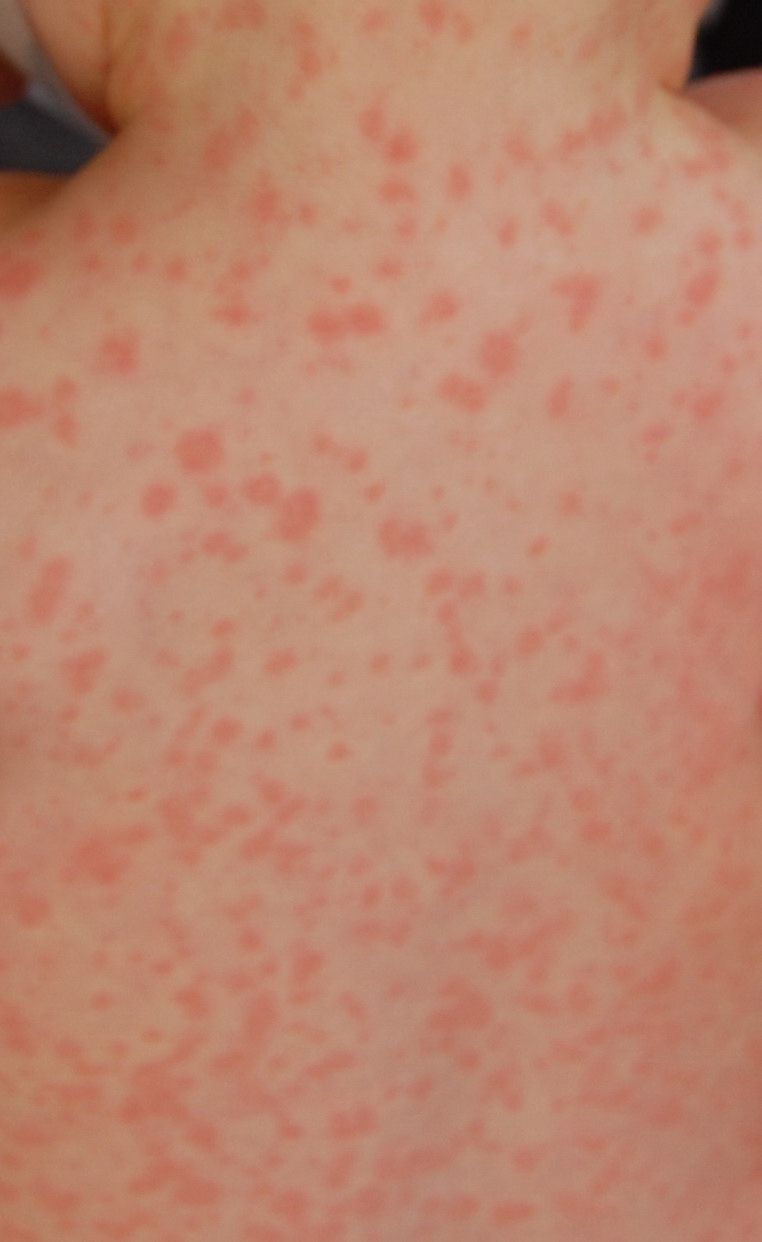 Amoxicillin rash in patients with infectious mononucleosis ...