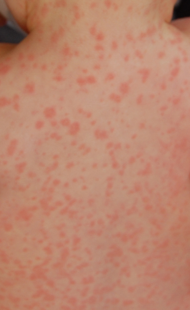 rashes after antibiotics