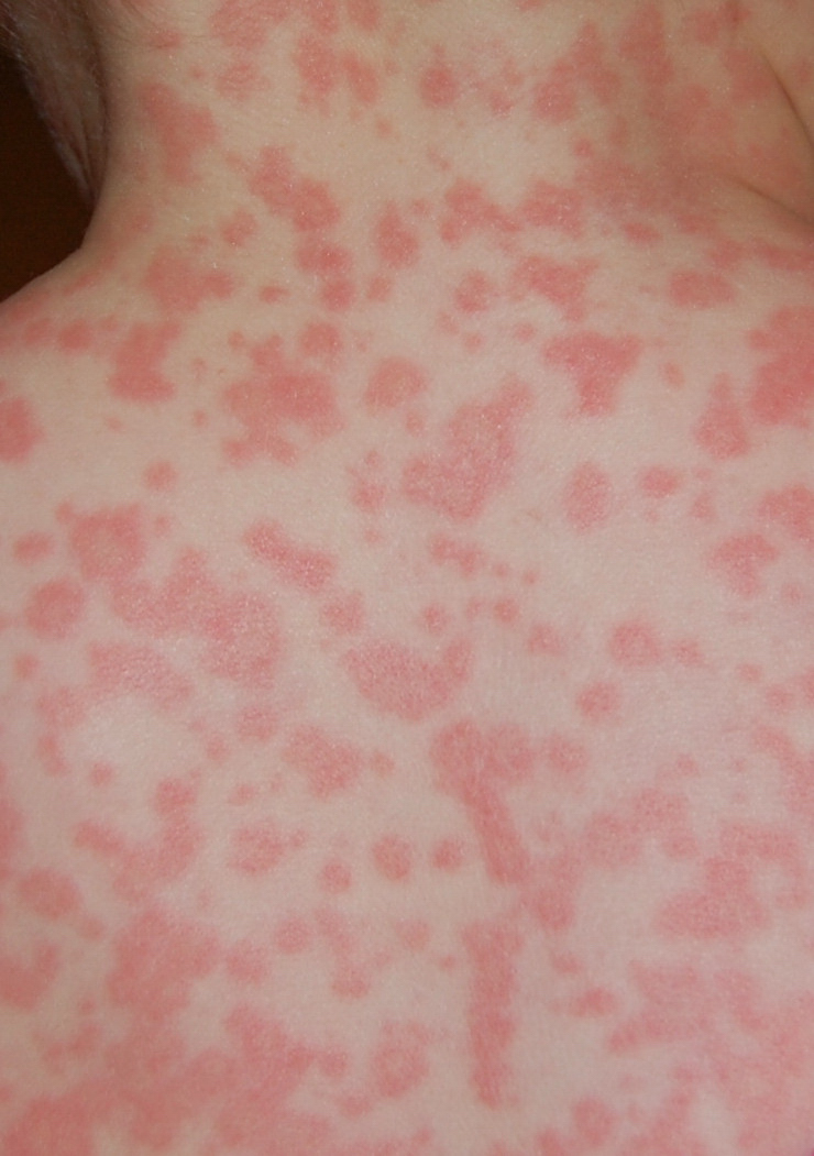 Picture 3 – Amoxicillin Rash Photo