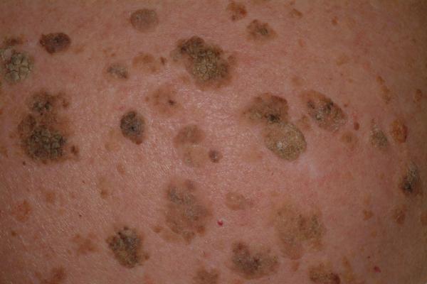 Seborrheic Keratosis | 100% Natural Home Treatment