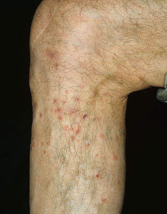 photos of flea bites on humans #9