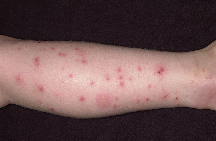 Pictures of Flea Bites on Humans Symptoms and Treatments