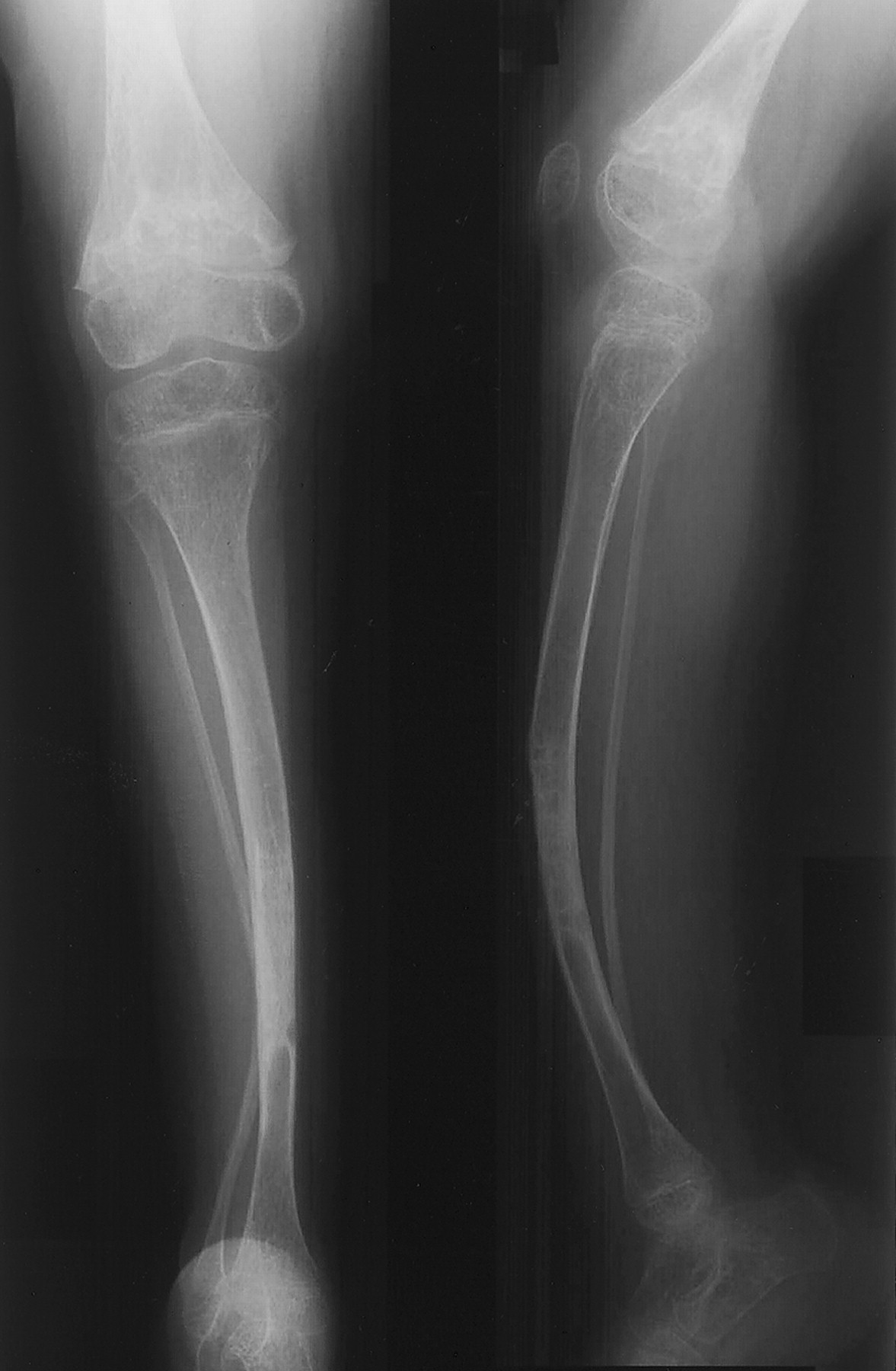 Resultado de imagem para Adult with imperfect osteogenesis