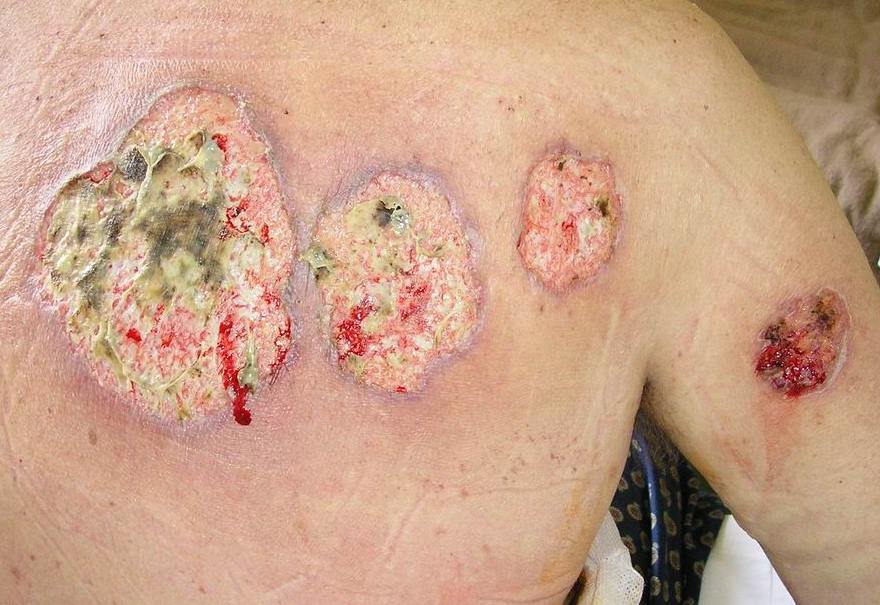 pyoderma gangrenosum images #10