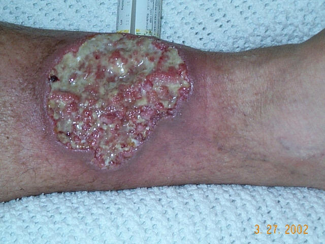 Pyoderma gangrenosum - Wikipedia