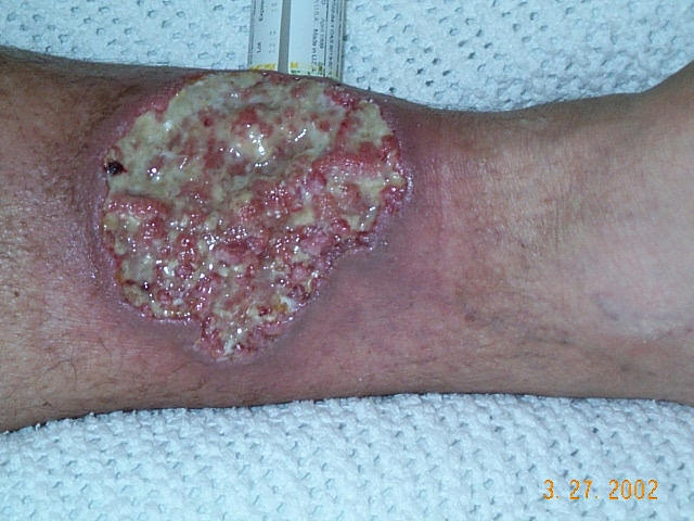 pyoderma gangrenosum pictures #10