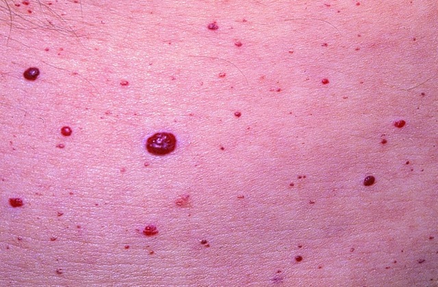 Cherry Angioma - Pictures, Removal, Causes, Home Treatment