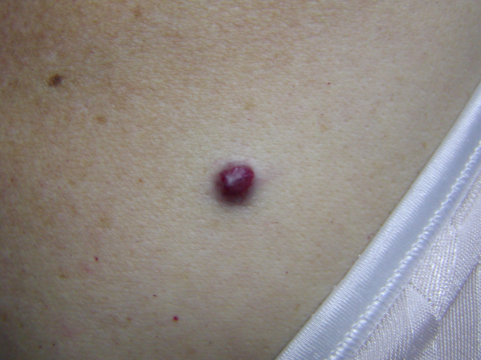 Online Dermatology - Angioma