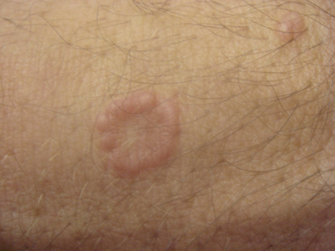 Circular Skin Rash Not Ringworm - Skin Care - Healthy Skin