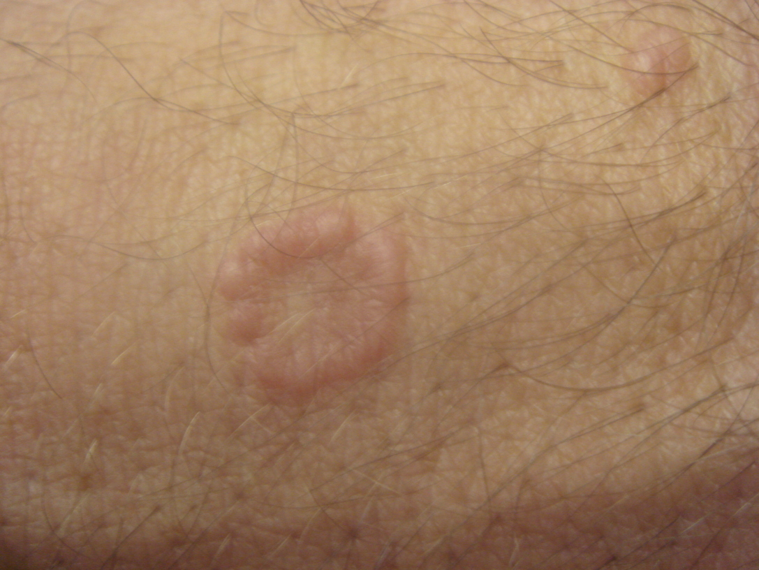 Slide show: Common skin rashes - Mayo Clinic