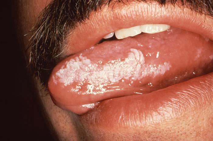 leukoplakia symptom