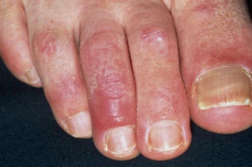 Chilblains - Pictures, Symptoms, Causes and Treatment