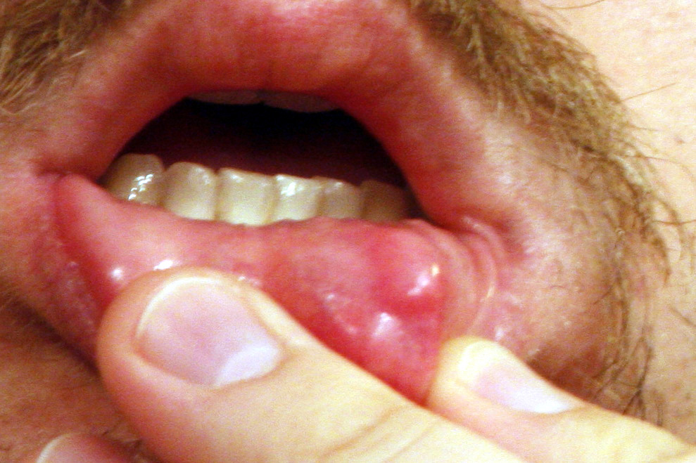 Mucocele: Causes, Symptoms, and Treatment - WebMD