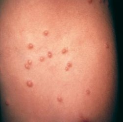 Molluscum Contagiosum In Children And Adults Pictures Causes