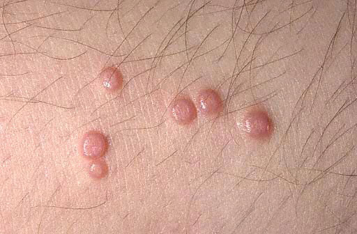 Genital Molluscum Contagiosum Treatment molluscum contagiosum in 