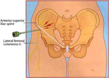 Steroid injection during pregnancy