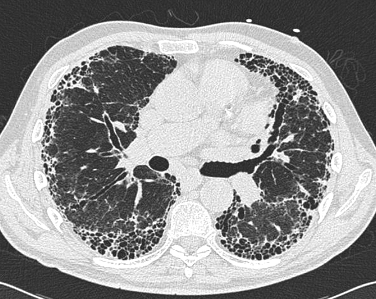 Multiple Sclerosis And Pulmonary Fibrosis