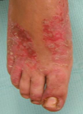 Spongiotic dermatitis | definition of spongiotic ...