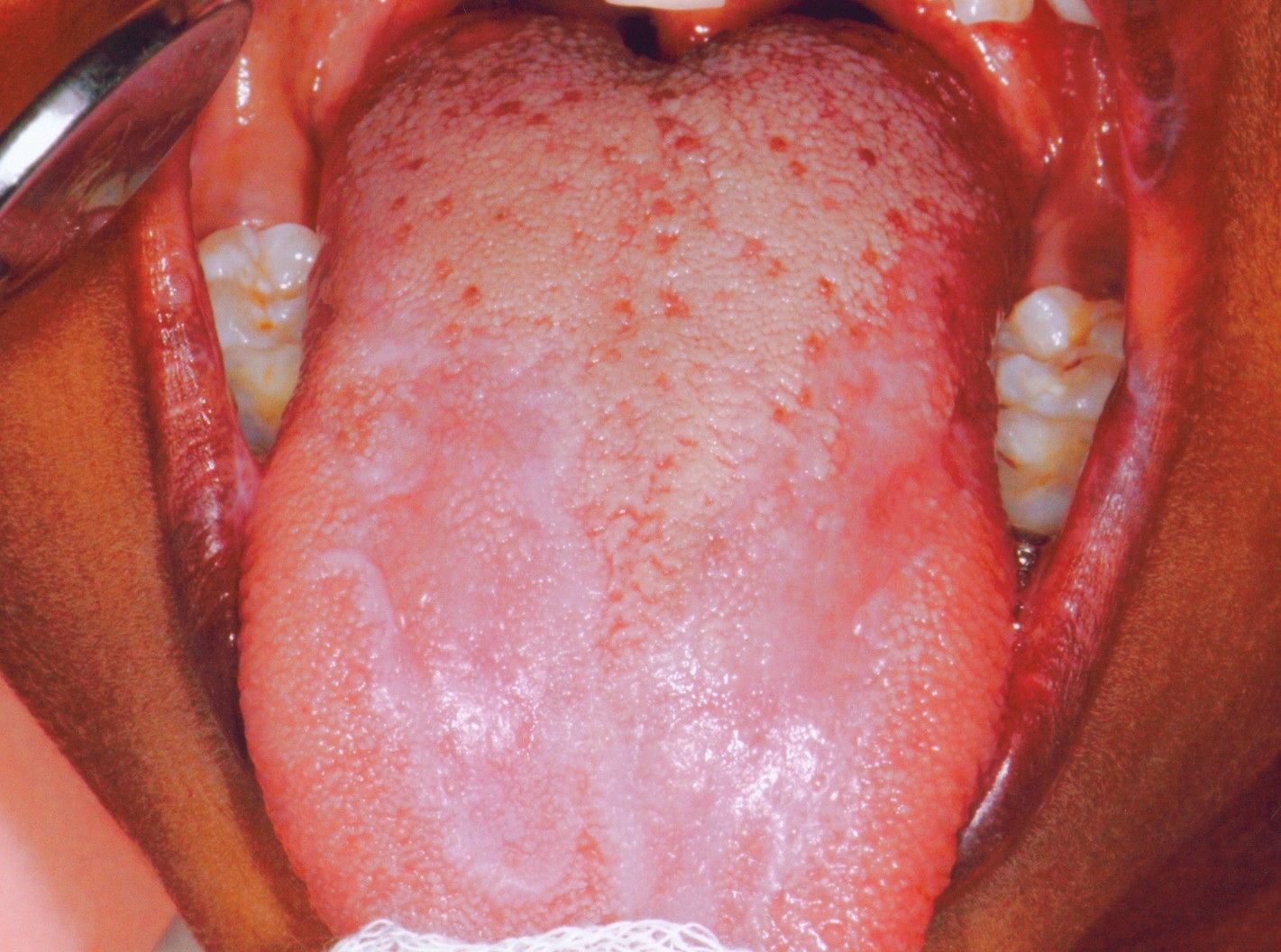 Oral lichen planus Overview - Mayo Clinic