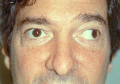 strabismus adults Treatment