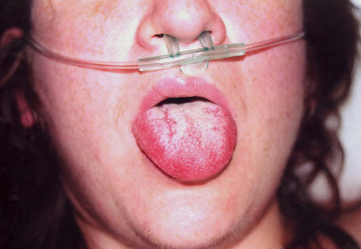 scarlet fever tongue #9