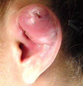 infected cartilage piercing