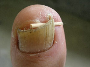 ingrown toenail treatment