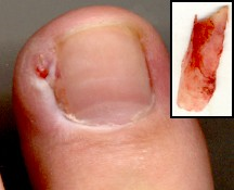 ingrown toenail surgery