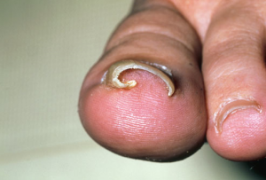 ingrown toenail causes