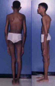 skeletal abnormality in marfan syndrome