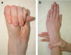 marfan syndrome pic