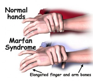 marfan syndrome picture