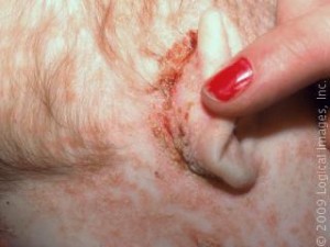 seborrheic Dermatitis pictures