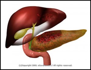 acite pancreatitis