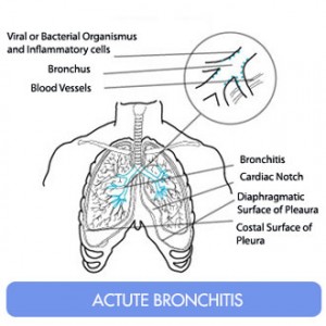 Coughing Up Phlegm - bronchitis pictures